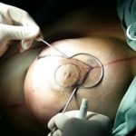 Dr. Pedro Jerez, Cirugia de mama, reduccion, reconstruccion, ciruplastica,