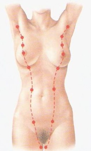 Linea mamaria en un cuerpo femenino, a lo largo de este puede ser encontrado por anomalías del desarrollo tejido mamario.